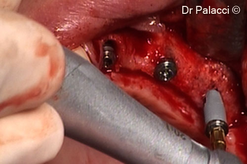 7. The lateral incisor is extracted and the recreated ridge can be seen
