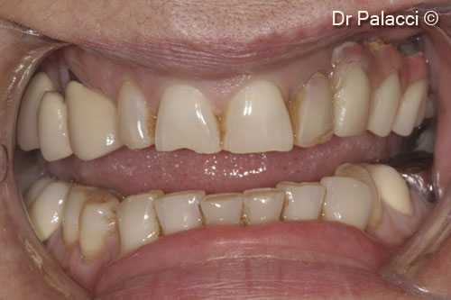 1. Clinical situation. Implant supported restoration upper left. Teeth supported restoration upper right