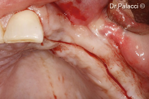 10. Four months later a flap is elevated and abutments placed into a very stable bone (ISQ ostell between 72 and 78)
