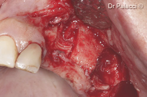 3. Implants are removed. Major bone loss defects can be seen