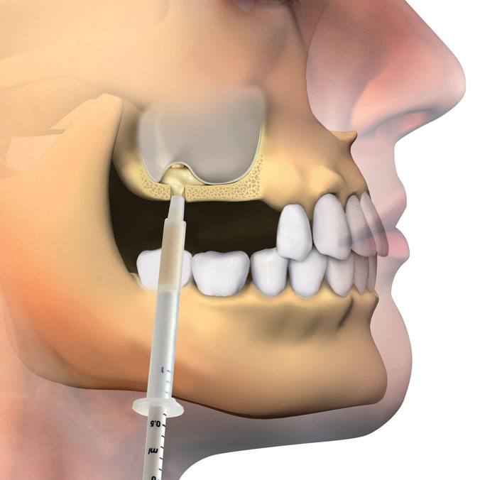 Osteobiol crestal access sinus lift