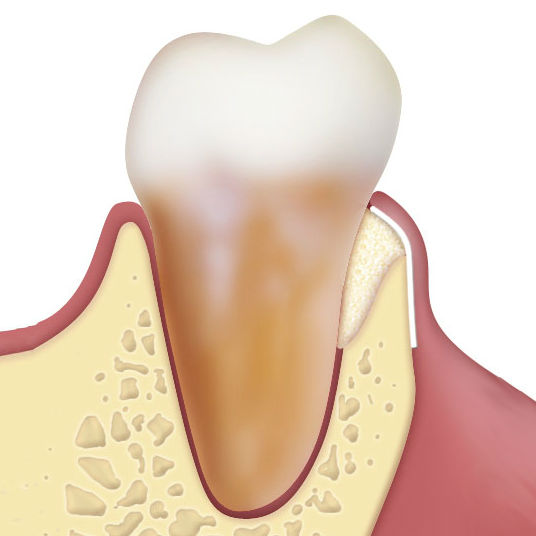 Osteobiol periodontal regeneration