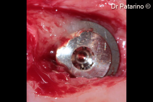 8 - Bony tissue above the healing cap