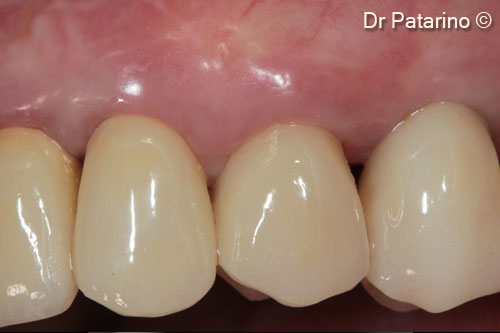 Implant positioning in the esthetic...