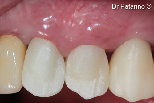 20 - Result after 7 months – final impression and esthetic test