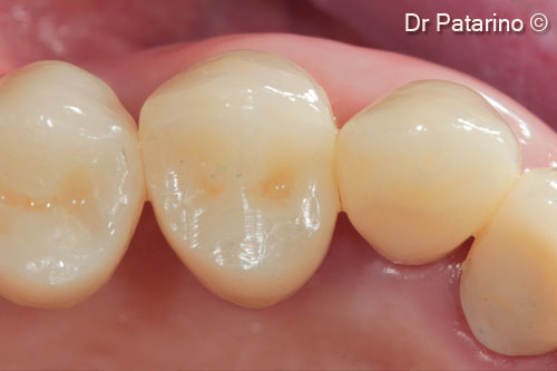 26 - Cemented prosthesis – occlusal view