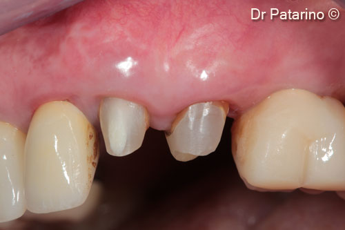 18 - Guided tissue regeneration at 2 months