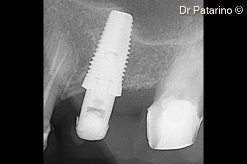 25 - BOPT preparation of the abutment and Switching Platform