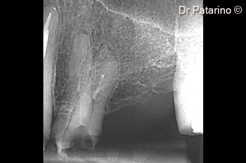 2 - Initial endoral x-ray, showing 7-mm bone height low mineralization of the residual crest