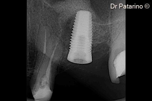 3 - Endoral x-ray after implant positioning, with crestal access sinus lifting, OsteoBiol® <i>Evolution</i> and bone chips on the bony crest
