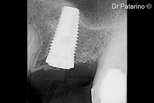 6 - Endoral x-ray at flap opening after 9 months