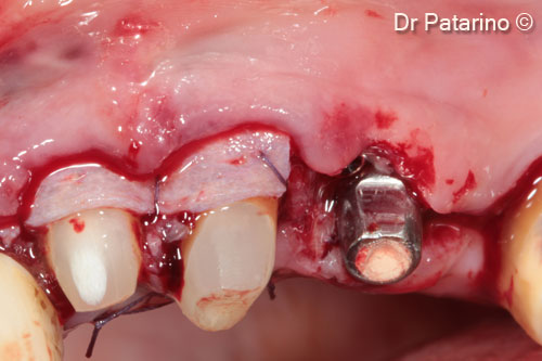 11 - OsteoBiol® <i>Derma</i> sutured at the CEJ of the 2 abutments