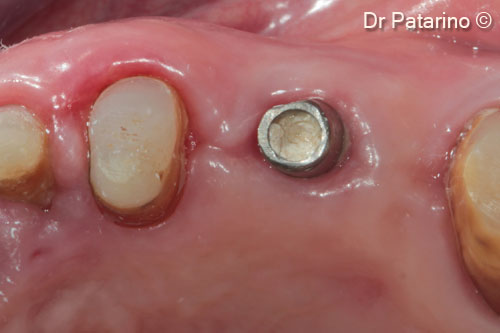 15 - Healing at 20 days