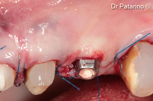 13 - Suture