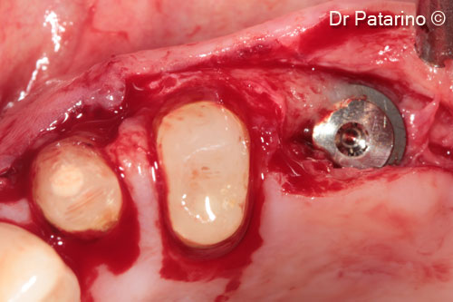 7 - Flap to preserve the papilla preservation to access the implant