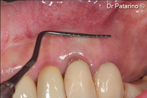 4 - Sufficient adhesive gingival height but minimum thickness that does not allow the maintenance of the right volumes