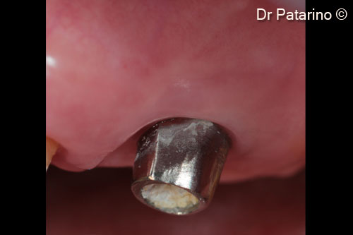 21 - Guided tissue regeneration around the implant at 7 months after the opening