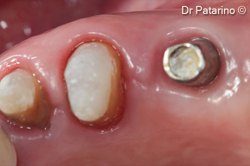 22 - Occlusal view – proper gingival volumes