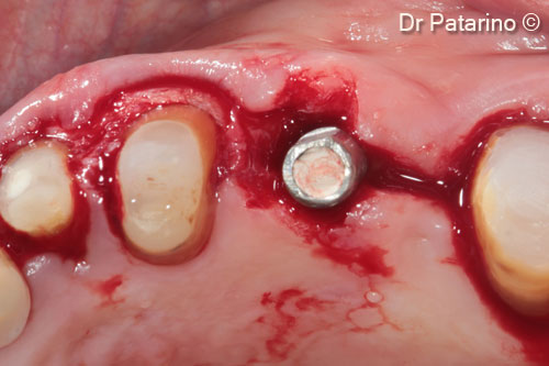 9 - BOPT preparation on natural abutments and implant abutment