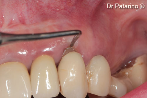 5 - Thickness of the adhesive gingiva