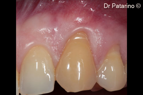 2 - Elements 2.3 and 2.4: gingival recessions of 3 and 4 mm from CEJ respectively (Miller Class I)