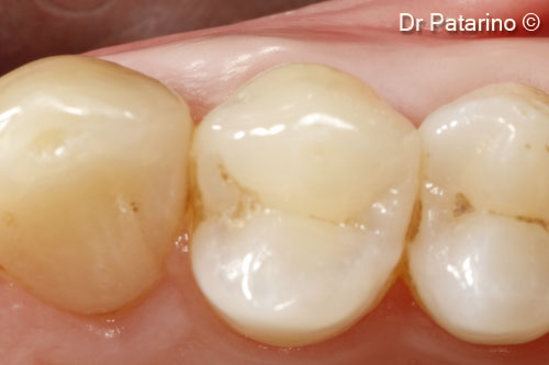 13 - Increase of the gingival thickness