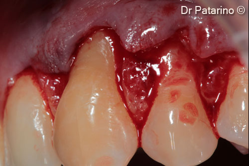 4 - Particular of the cervical abrasions of both elements and papillas