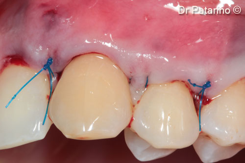 6 - Suture that covers the graft, with a good marginal adjustment of the flap