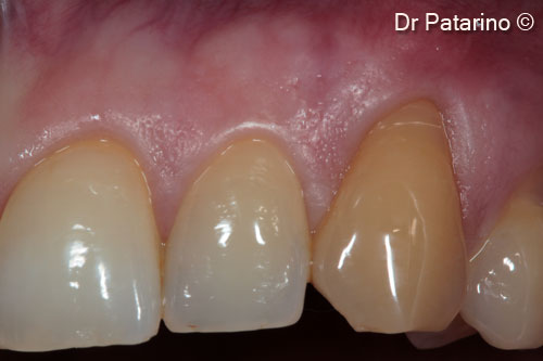 1 - Upper left hemiarch: gingival recessions in the lateral posterior area