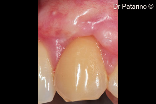 9 - Tissue healing at 30 days