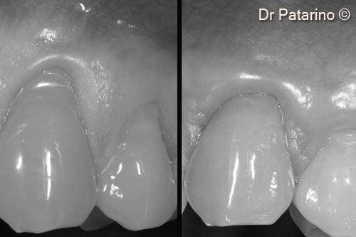 14 - B/w comparison between the initial situation and the result after 11 months. Note the increase of keratinized tissue and restoration of the mucogingival line