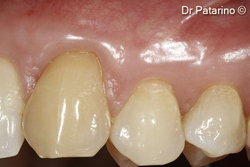 12 - Good esthetic result at 11 months after surgery