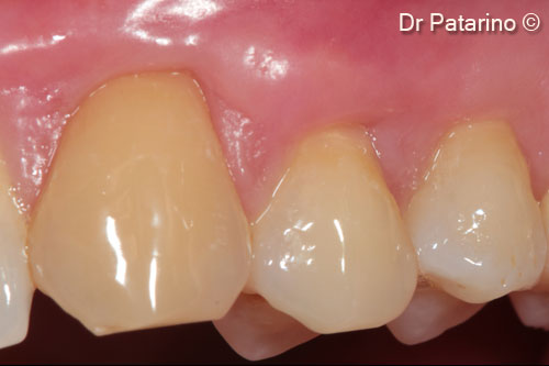 10 - Tissue healing at 2 months
