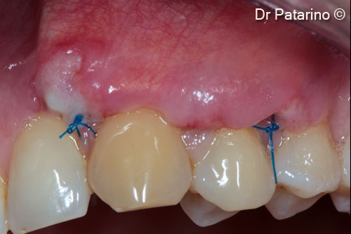 7 - Healing at 5 days: partial dehiscence of the flap at the acute mesial area of the graft