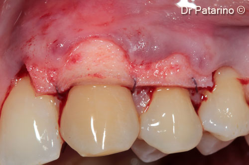 5 - OsteoBiol® <i>Derma</i> grafted and sutured to the receiving site, coronally to CEJ. Note the acute angle of the mesial graft at the canine