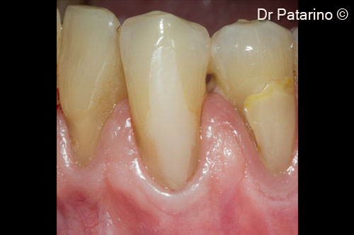 12 - Healing at 9 months: good coverage of the roots and levelling of the muco-gingival line