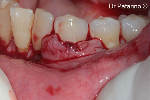 4 - Coronal mobilization of the flap