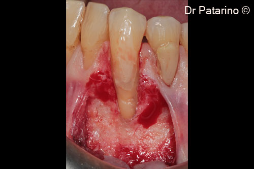 3 - Partial thickness trapezoidal flap and papillar dissection