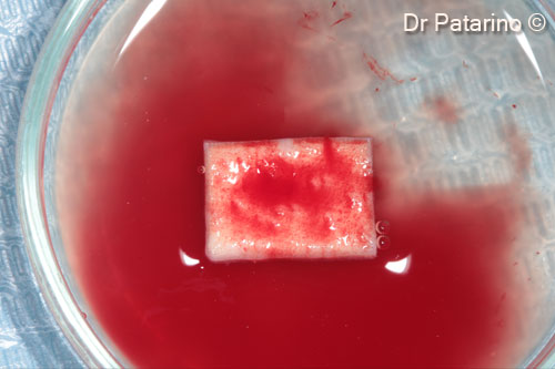 5 - OsteoBiol® <i>Derma</i> hydrated with saline and blood