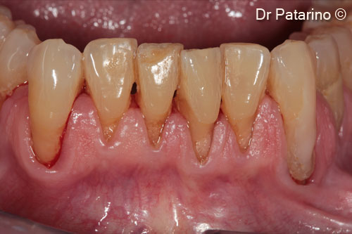 1 - Lower jaw: gingival recessions in the anterior region