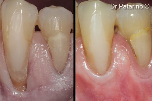 13 - Comparison between the initial situation and the tissues at 9 months