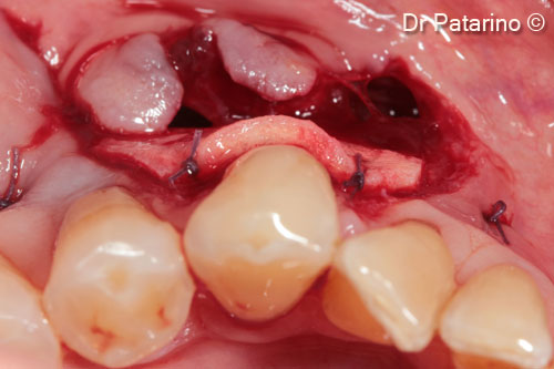 6 - Occlusal view of the graft sutured at the receiving site