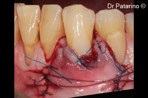 9 - Sutures to enhance the adaptation of the coronal margin of the flap to the dental convexity, single sutures to stabilize the flap