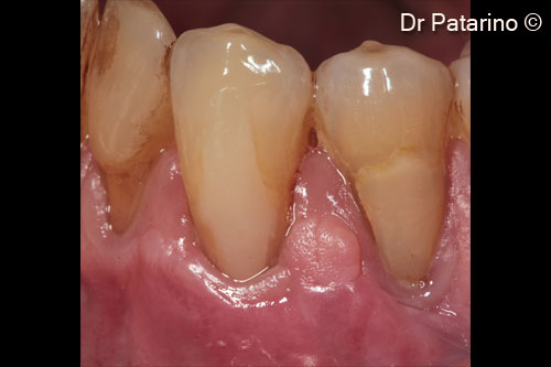 11 - Healing at 2 months: good coverage of the roots and levelling of the muco-gingival line