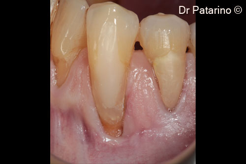 2 - Dental element 3.3: 10-mm Miller class II recession from CEJ