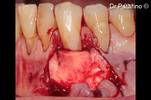 7 - OsteoBiol® <i>Derma</i> graft, shake and apically sutured to CEJ and stabilized laterally with resorbable suture to the receiving site