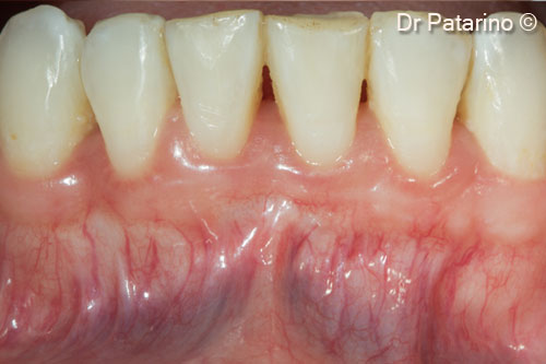 17 - 30 months after mucogingival  treatment : stability  of keratinized tissue and leveling of  the mucogingival morphology