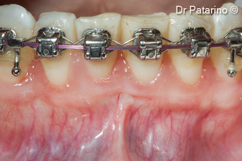 16 -  24 months after mucogingival treatment