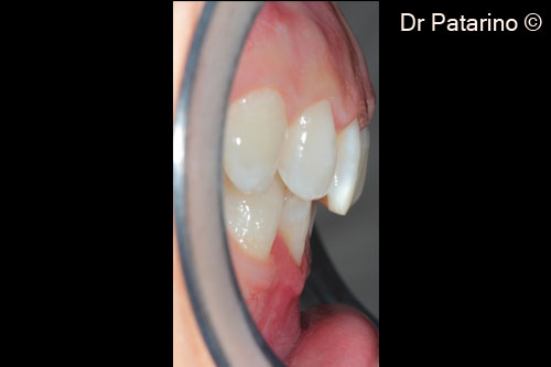 11 - Increase of thickness of the keratinized tissue
