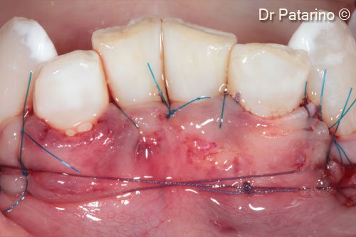 6 - Resorbable suture that covers the graft completely, with periostal anchorage to reduce the muscular tension on the flap